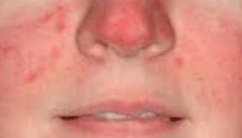 Rosacea-1 (1)