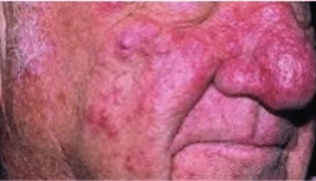 Rosacea-3